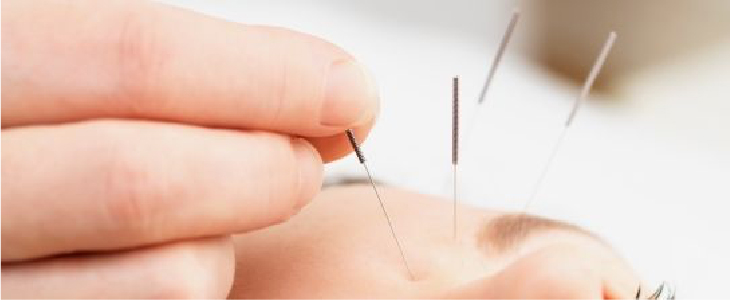 Acupuncture for Migraines